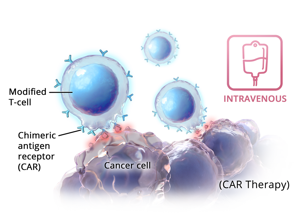 >Modified T-cell Chimeric antigen receptor (CAR) Cancer cell (CAR Therapy) INTRAVENOUS
